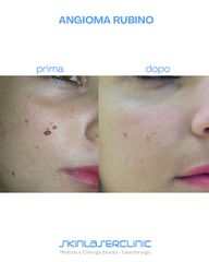 Skin Laser Clinic Angiomi