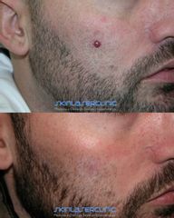 Skin Laser Clinic Angioma