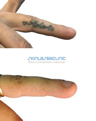 Skin Laser Clinic Rimozione tatuaggi
