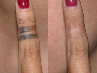Rimozione tatuaggi prima e dopo - 880452