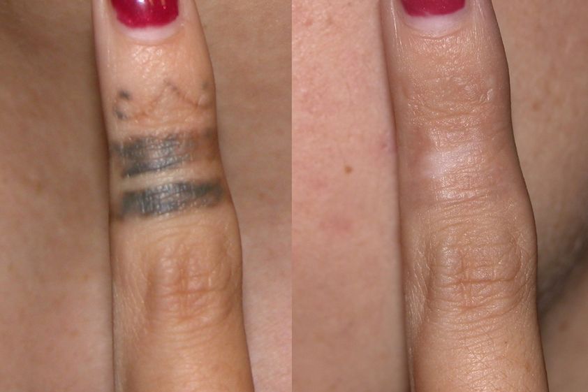 Rimozione tatuaggi prima e dopo - 880452