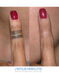 Skin Laser Clinic Rimozione tatuaggi
