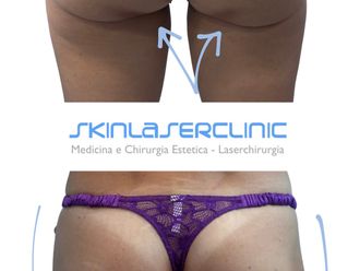 Gluteoplastica prima e dopo - 880621