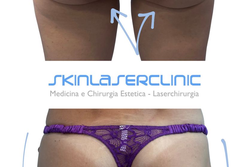 Gluteoplastica prima e dopo - 880621