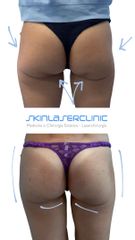 Skin Laser Clinic Rimodellamento glutei acido polilattico