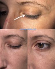 Skin Laser Clinic Fibroma pendulo occhio