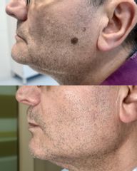 Skin Laser Clinic Rimozione chetatosi seborroica