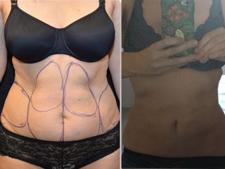 liposuzione prima dopo