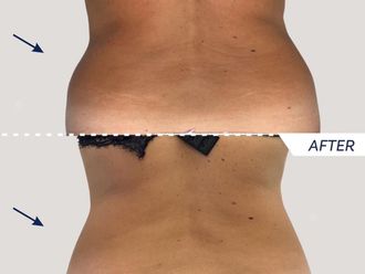 EMSculpt® prima e dopo - 867460