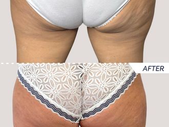 Cellulite prima e dopo - 867462