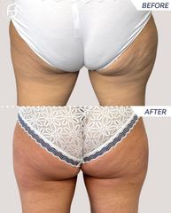 Cellulite - Dott.ssa Francesca Flagiello