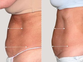 EMSculpt® prima e dopo - 867463