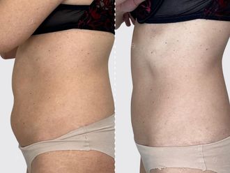 EMSculpt® prima e dopo - 867464