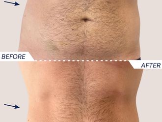 EMSculpt® prima e dopo - 867467