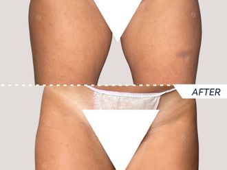 EMSculpt® prima e dopo - 867472