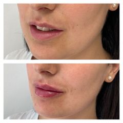 Filler labbra - Pre e Post trattamento