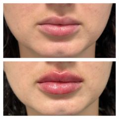 Filler labbra - Pre e Post trattamento