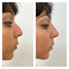 Filler naso - Pre e Post trattamento