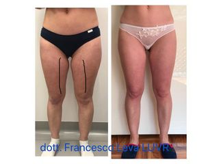 Liposuzione prima e dopo