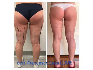 Liposuzione prima e dopo