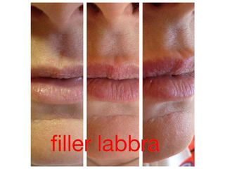 Filler labbra prima e dopo