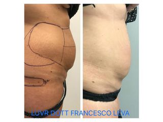 Liposuzione prima e dopo
