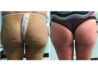 Gluteoplastica prima e dopo