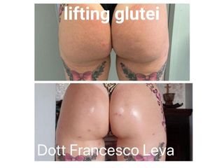 lifting gluteti prima e dopo