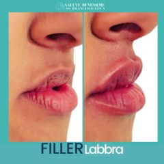 Filler labbra  - Dott. Francesco Leva
