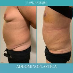 Addominoplastica - Dott. Francesco Leva