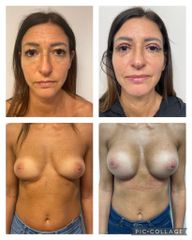 Mastoplastica additiva e Blefaroplastica - Prof. Francesco Leva