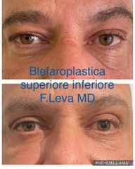 Blefaroplastica - Prof. Francesco Leva