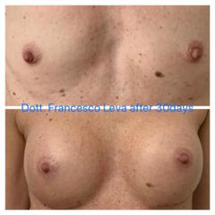 Mastoplastica additiva - Prof. Francesco Leva