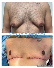 Ginecomastia - Prof. Francesco Leva