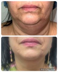 Liposuzione - Prof. Francesco Leva