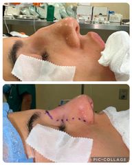 Rinoplastica - Prof. Francesco Leva