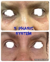 Eliminare occhiaie - Prof. Francesco Leva