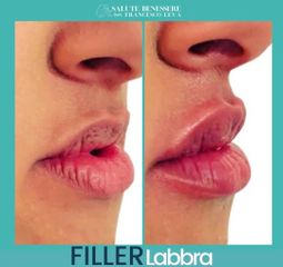 Filler labbra - Prof. Francesco Leva
