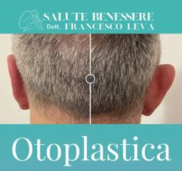 Otoplastica - Prof. Francesco Leva