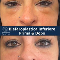 Blefaroplastica inferiore - Prof. Francesco Leva