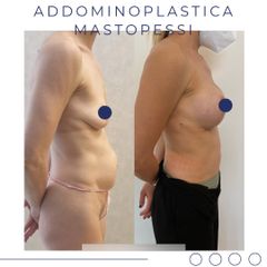 Addominoplastica - Dott. Alessandro Ticozzi