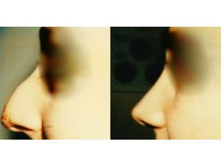 Rinoplastica prima e dopo