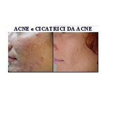 Cicatrici da acne prima e dopo