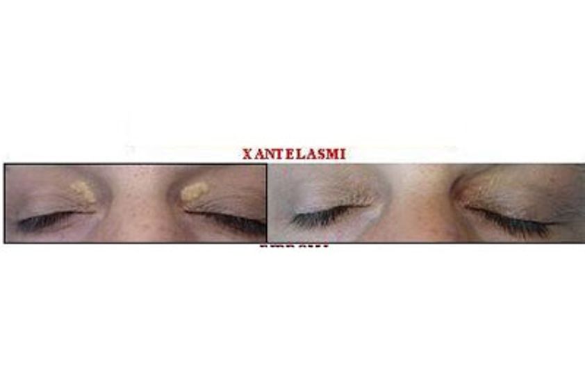 Xantelasmi prima e dopo - 744322