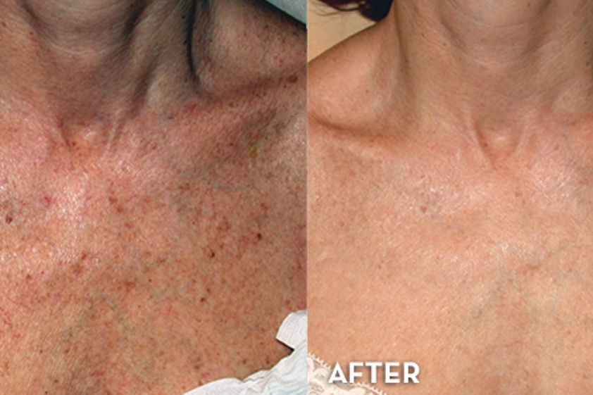Needling prima e dopo - 747043