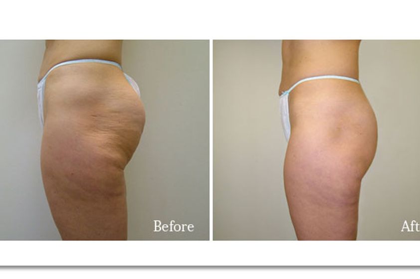 Velashape prima e dopo - 747045