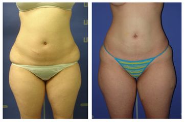 Lipodissolve + cavitazione  pancia
