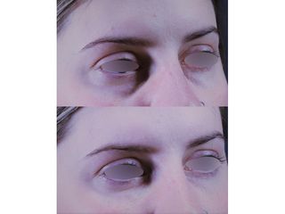 Eliminare occhiaie - Dr. Zunica Roberto
