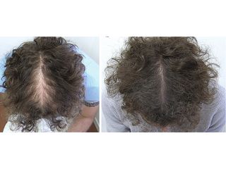 Trapianto capelli - Dr. Zunica Roberto