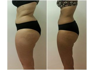 Mesoterapia - Dott. Carlo Lampignani